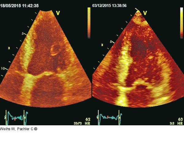 Linksventrikuläre Kontraktilität