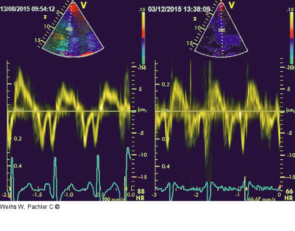 Systolische Linksventrikelfunktion