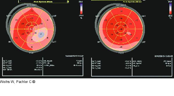 Longitudinale Strains