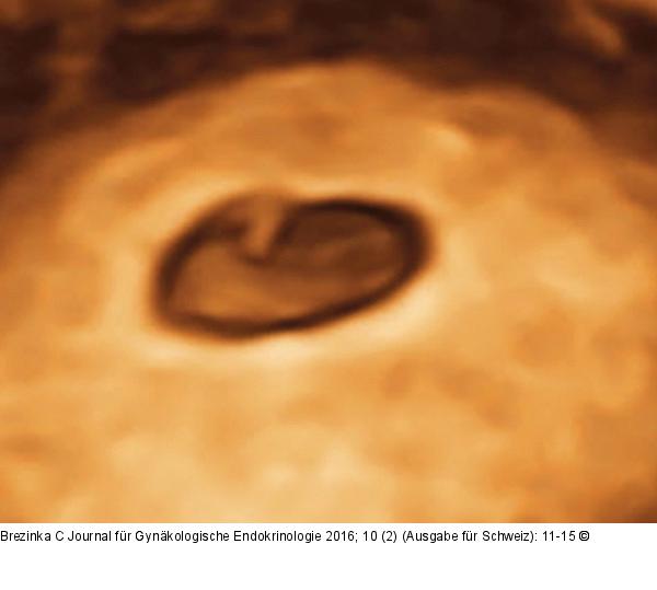 Ultraschall-Dottersack