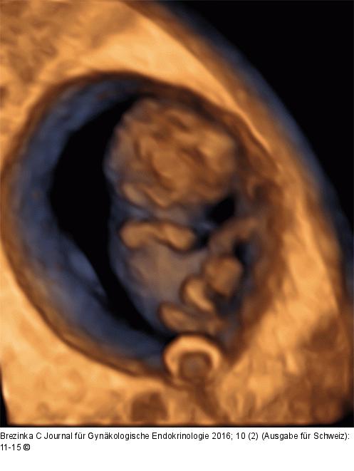 Ultraschall-Dottersack