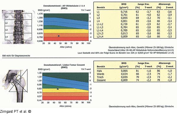 Osteodensitometrie-Befund