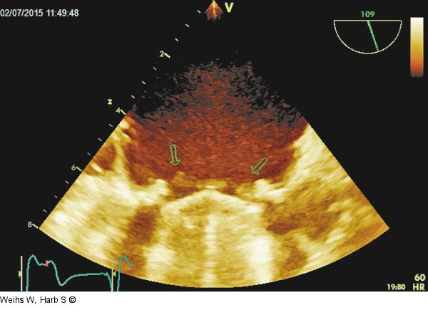 Mitralklappenprothese