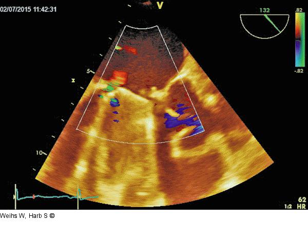 Mitralklappenprothese - Regurgitation