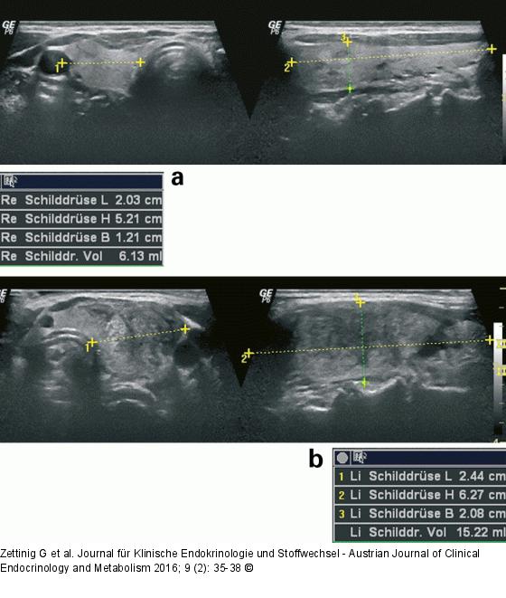Subakute Thyreoiditis