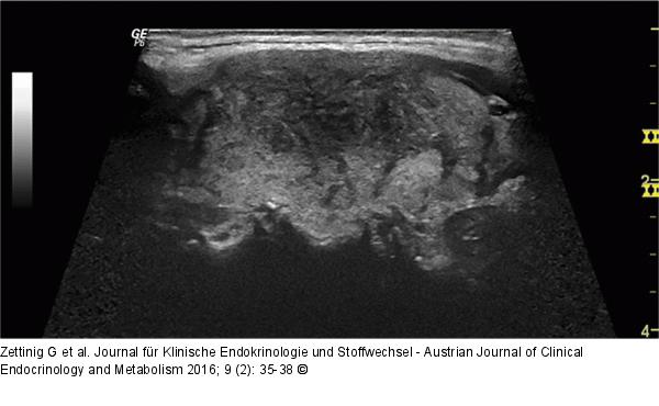Subakute Thyreoiditis
