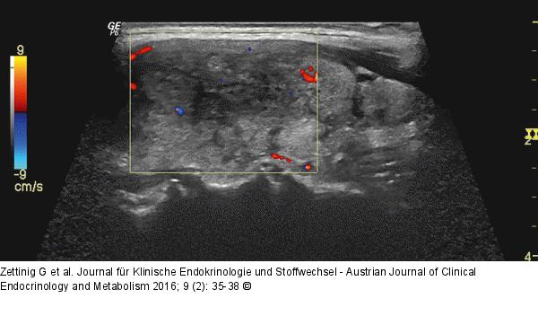 Subakute Thyreoiditis