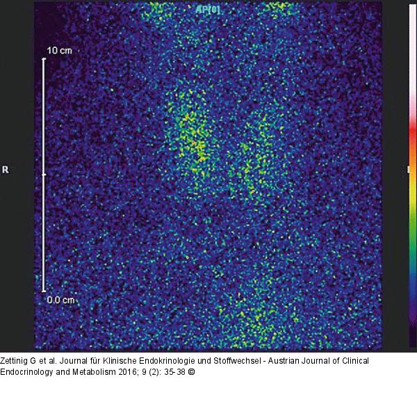 Subakute Thyreoiditis