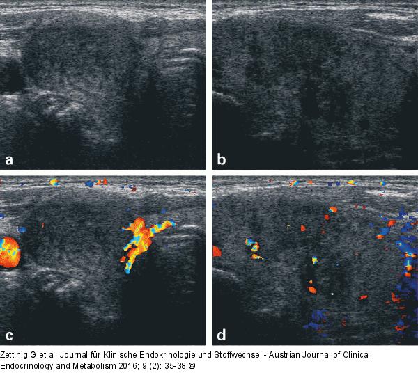 Subakute Thyreoiditis