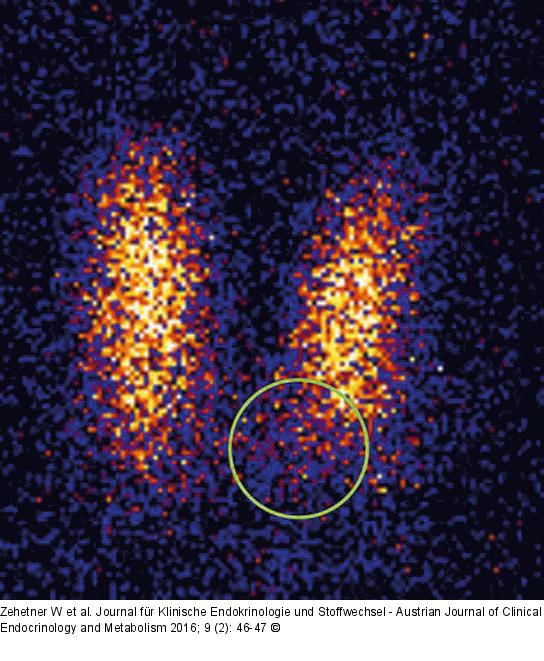 Schilddrüsenkarzinom