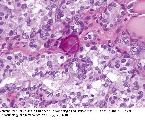 Schilddrüsenkarzinom