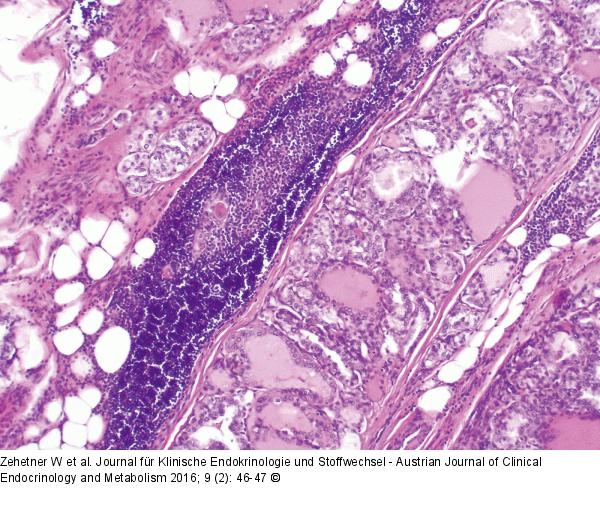 Schilddrüsenkarzinom