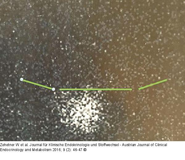 Schilddrüsenkarzinom