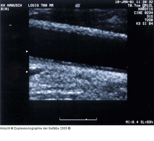 Duplexsonographie - Karotis