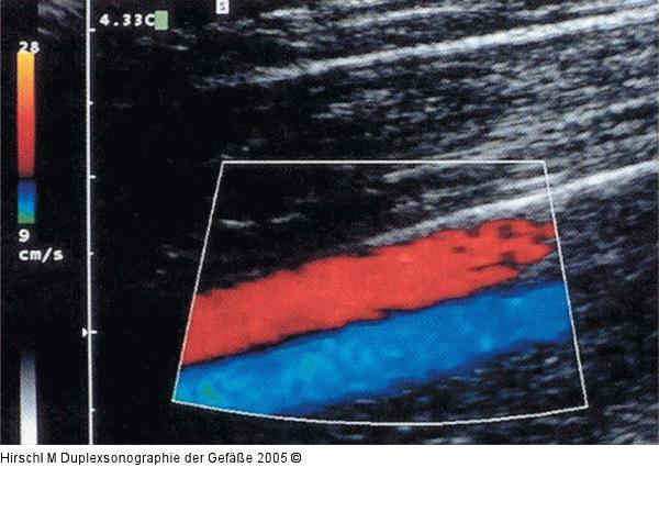 Duplexsonographie - Arteria/Vena poplitea