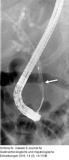 Choledochuskonkrement