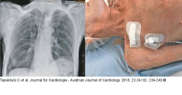 Herzchirurgie - Post-OP
