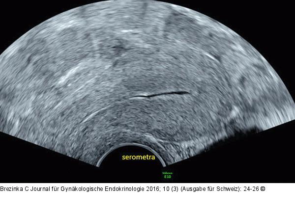 Ultraschall-Serometra