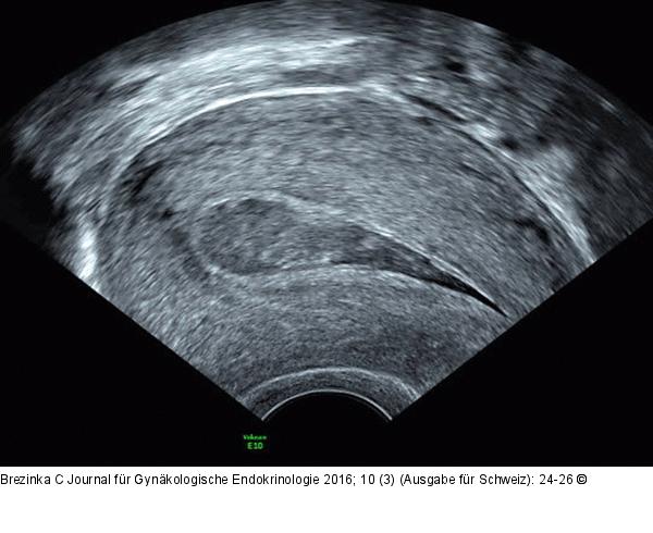 Ultraschall-Serometra