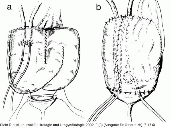 Mainz-Pouch-Substitution