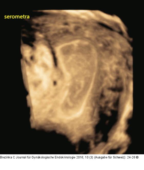 Ultraschall-Serometra