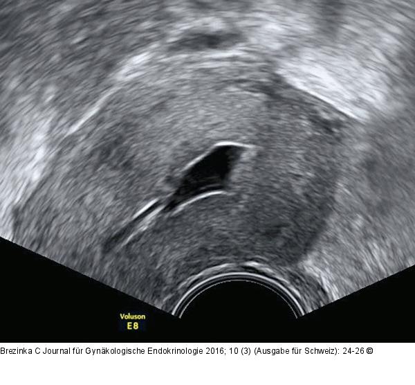 Ultraschall-Serometra