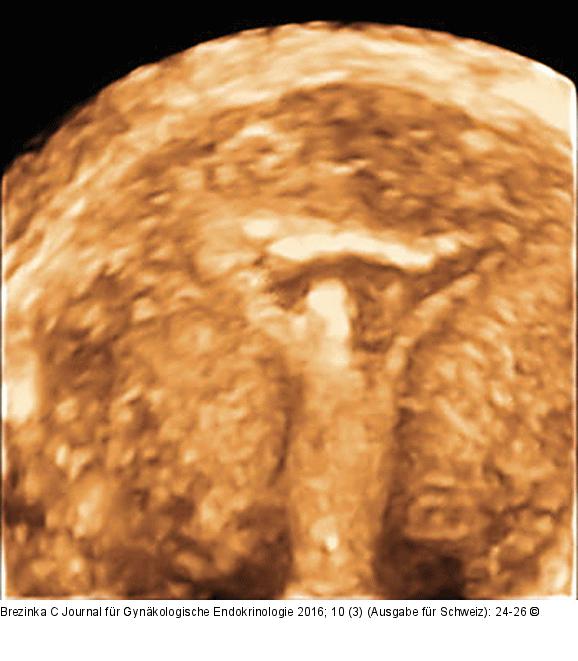Ultraschall-Serometra