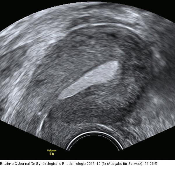 Ultraschall-Serometra