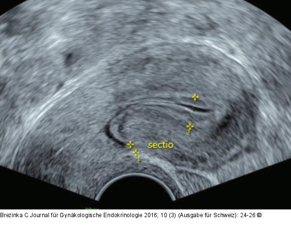 Ultraschall-Serometra