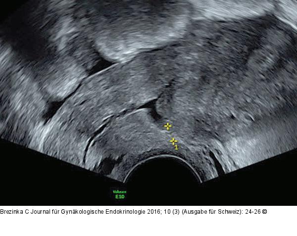 Ultraschall-Serometra