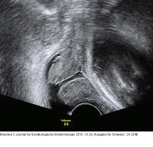 Ultraschall-Serometra