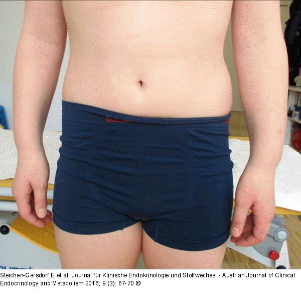 Madelung-Deformität