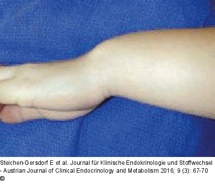 Madelung-Deformität