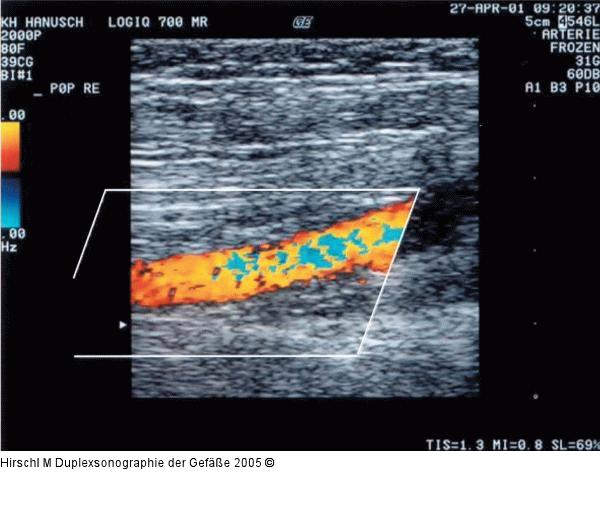 Duplexsonographie - PRF