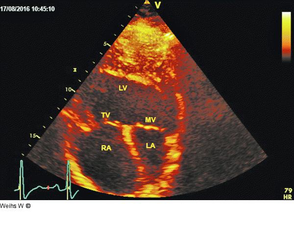 Apikaler Vierkammerblick