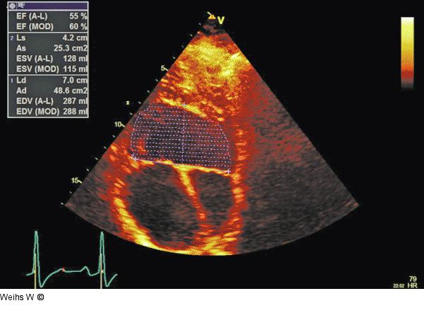 Linksventrikuläre Volumina - EF