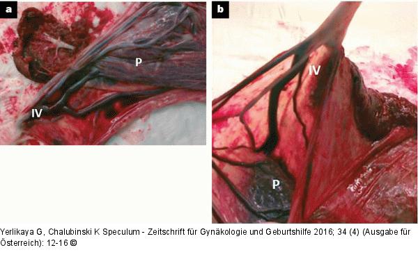 Insertio velamentosa