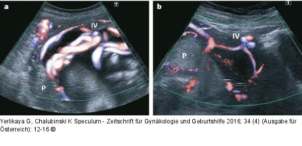 Insertio velamentosa