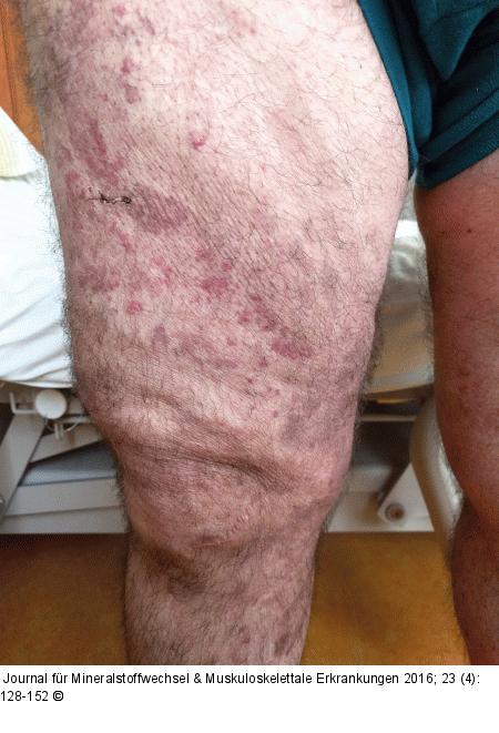 Kutane leukozytoklastische Vaskulitis