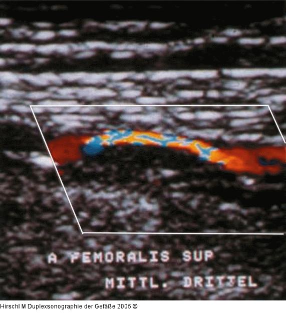 Duplexsonographie - Alias-Effekt