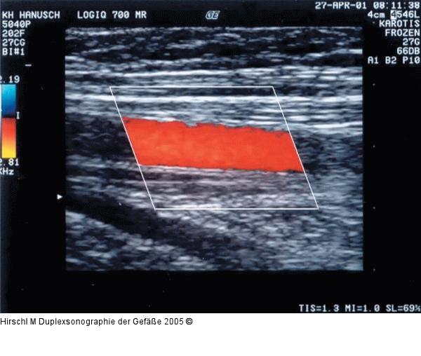Duplexsonographie - Farbfenstereinstellung