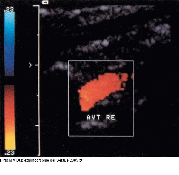 Duplexsonographie - Farbfenstereinstellung