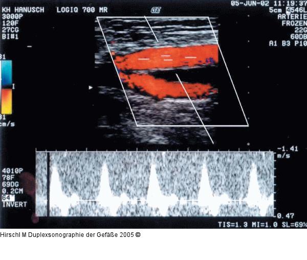 Duplexsonographie - Pulsdoppler