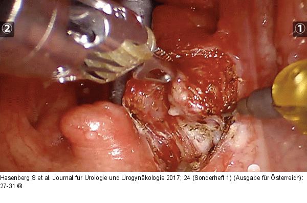Transorale Tumorresektion