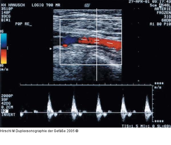Duplexsonographie - Pulsdoppler
