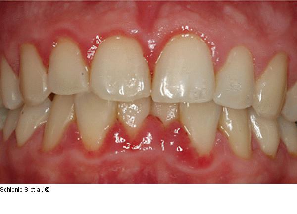 Schwangerschaftsgingivitis