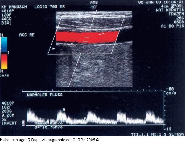 Duplexsonographie - Karotis