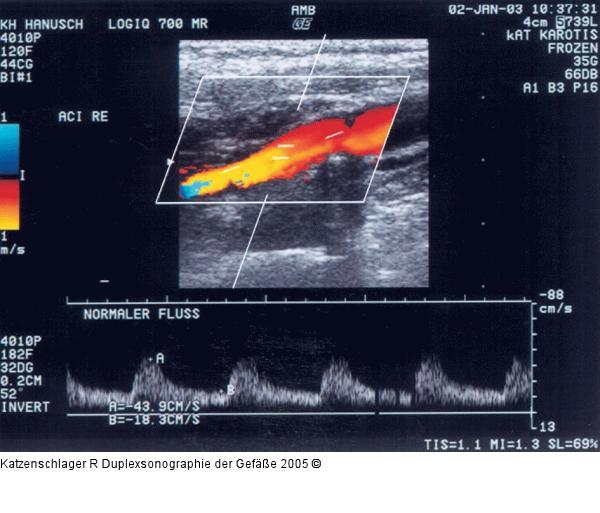 Duplexsonographie - Karotis