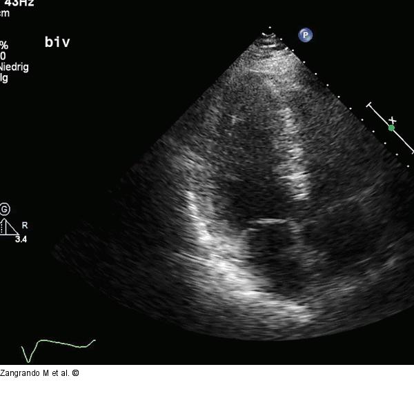 Echokardiographie - Film 4