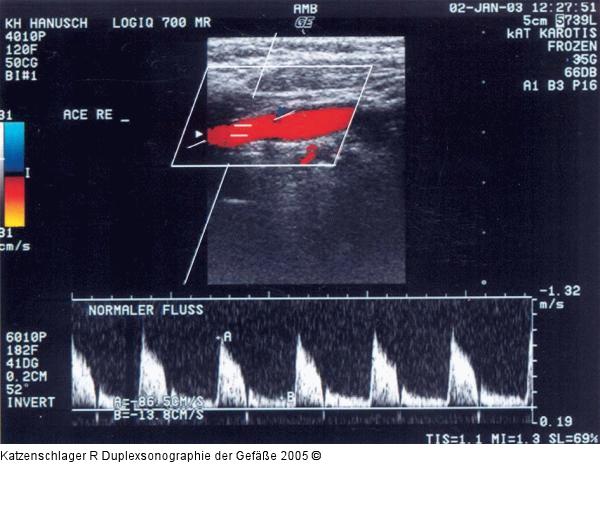 Duplexsonographie - Karotis